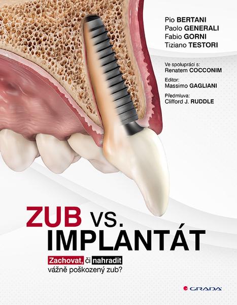 Zub vs. implantát - 9788027157846